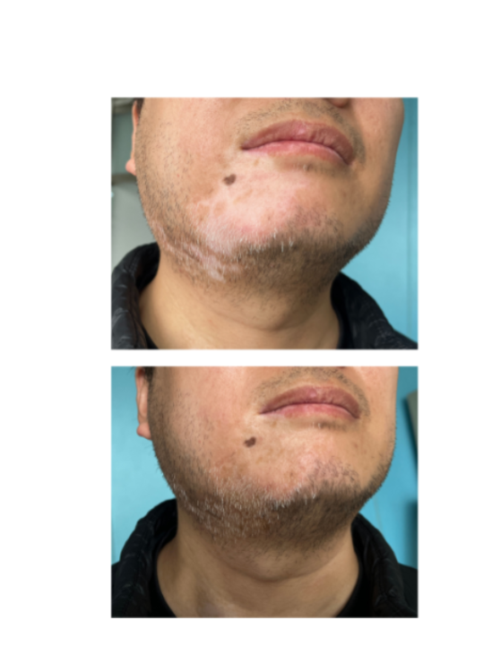 Real user lower face before and after ZHEZHI cosmetic coverage