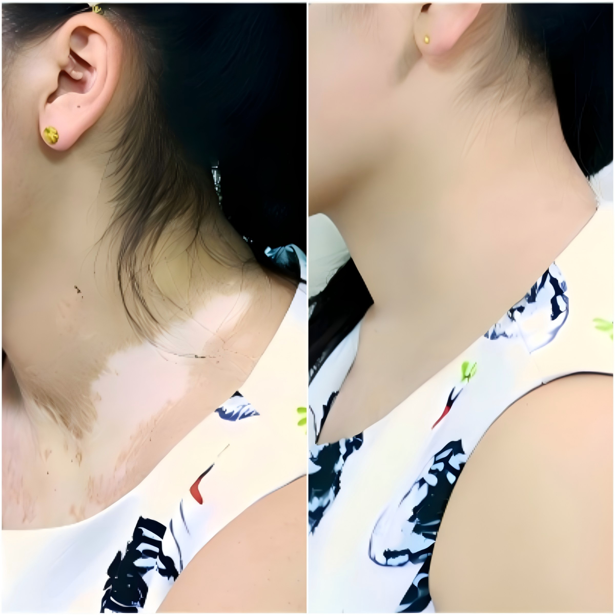 Real user neck before and after ZHEZHI cosmetic coverage