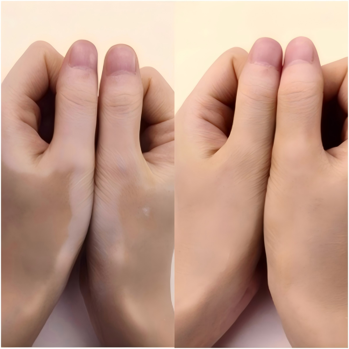Real ZHEZHI user hand result before and after cosmetic coverage